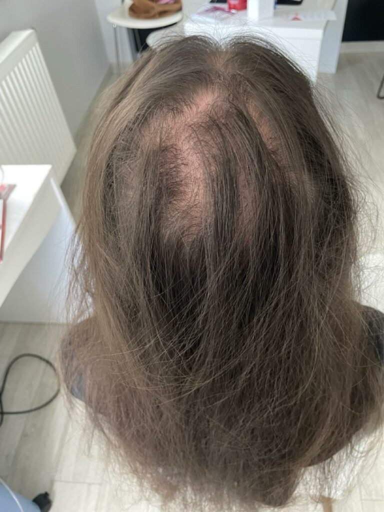 Sukces tego przypadku opierał się na bardzo dobrej współpracy z pacjentką, która zaufała moim zaleceniom i systematycznie stosowała wszystkie wskazówki. Dzięku temu udało nam się osiągnąć widoczne i trwałe efekty, a zdrowe włosy stały się jej codziennością. Obecnie pacjentka kontynuuje zabiegi przypominające, aby utrzymać pozytywne rezultaty.