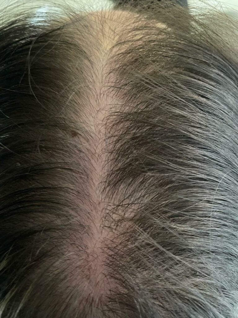 Sukces tego przypadku opierał się na bardzo dobrej współpracy z pacjentką, która zaufała moim zaleceniom i systematycznie stosowała wszystkie wskazówki. Dzięku temu udało nam się osiągnąć widoczne i trwałe efekty, a zdrowe włosy stały się jej codziennością. Obecnie pacjentka kontynuuje zabiegi przypominające, aby utrzymać pozytywne rezultaty.