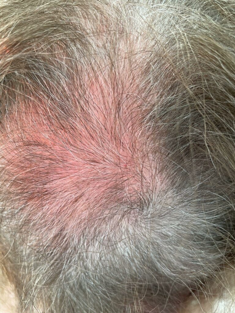 Łysienie polekowe może być skutkiem toksycznego działania leków na mieszki włosowe. W większości przypadków włosy odrastają po odstawieniu leku, ale czasem uszkodzenia są trwałe. Szybka konsultacja z trychologiem i odpowiednia terapia, np. mezoterapia czy laseroterapia, zwiększają szanse na regenerację. Milena Trycholog Bydgoszcz