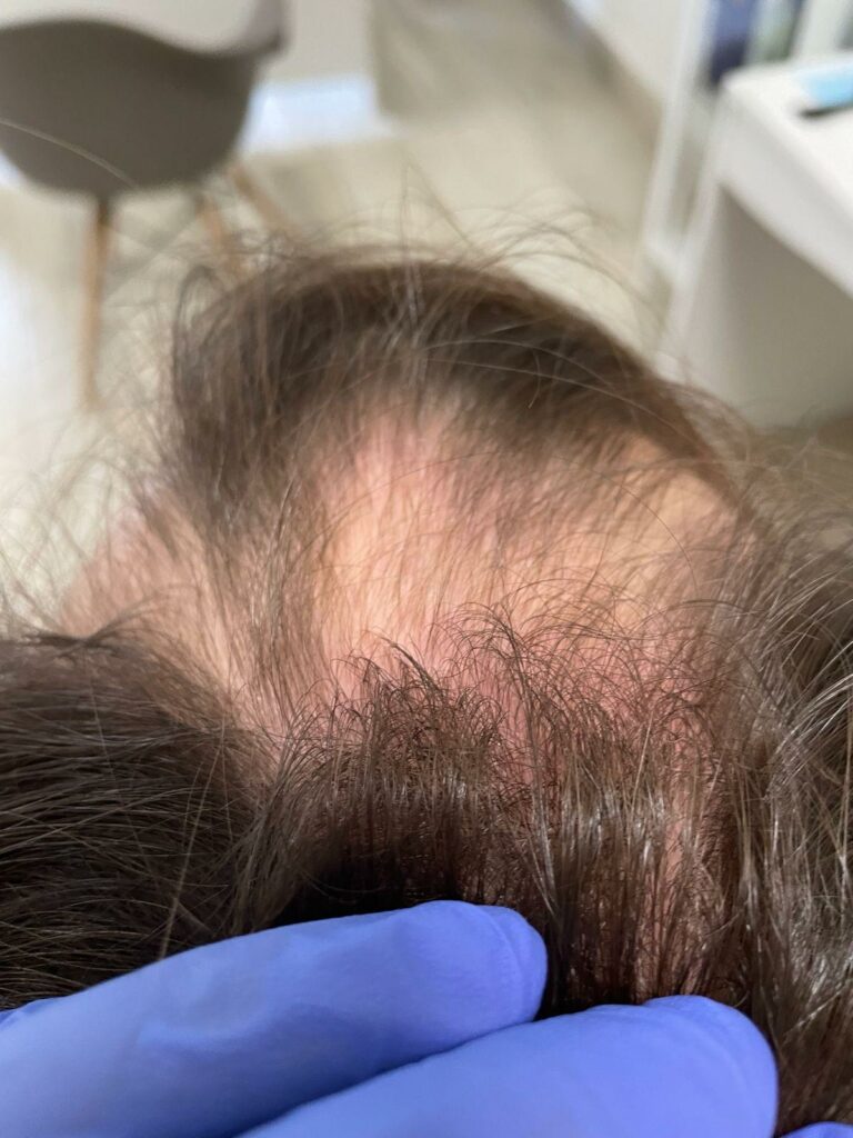 Wczesne rozpoznanie łysienia androgenowego znacząco zwiększa skuteczność terapii, dając szansę na zahamowanie procesu i poprawę gęstości włosów.