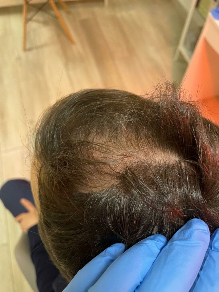 Wczesne rozpoznanie łysienia androgenowego znacząco zwiększa skuteczność terapii, dając szansę na zahamowanie procesu i poprawę gęstości włosów.