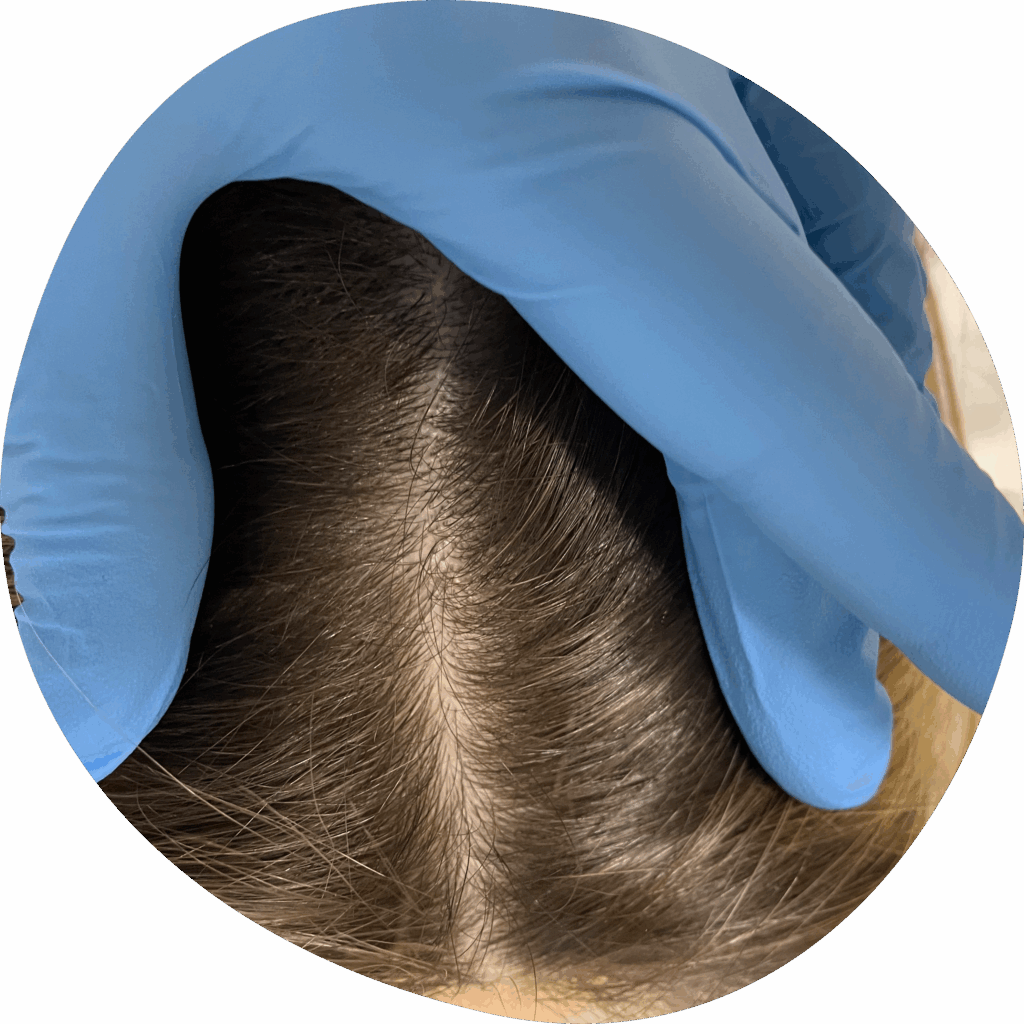hair loss trichologist Utrata włosów Problemy z włosami Łysienie Problemy skóry głowy Trycholog Pomoc Zabiegi Bydgoszcz Szwederowo Nowa 15