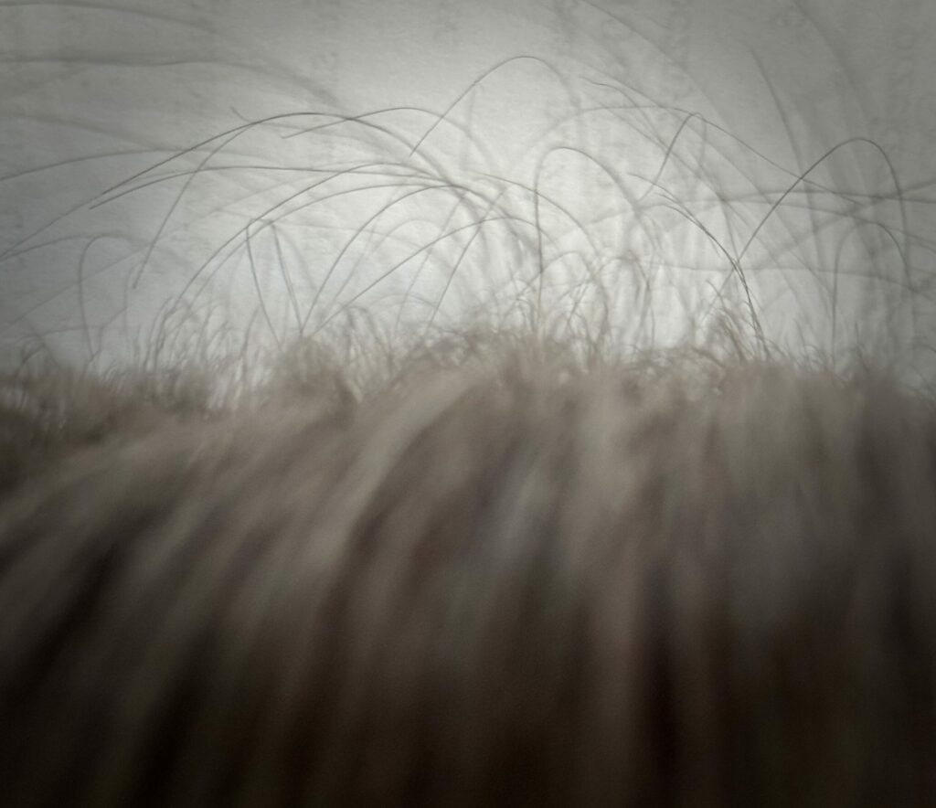 trichoskopia badanie trichoskopowe Badanie skóry głowy Przypadek z gabinetu: wymagająca skóra i wyzwania zdrowotne - Milena Trycholog Bydgoszcz https://milena-trycholog.pl