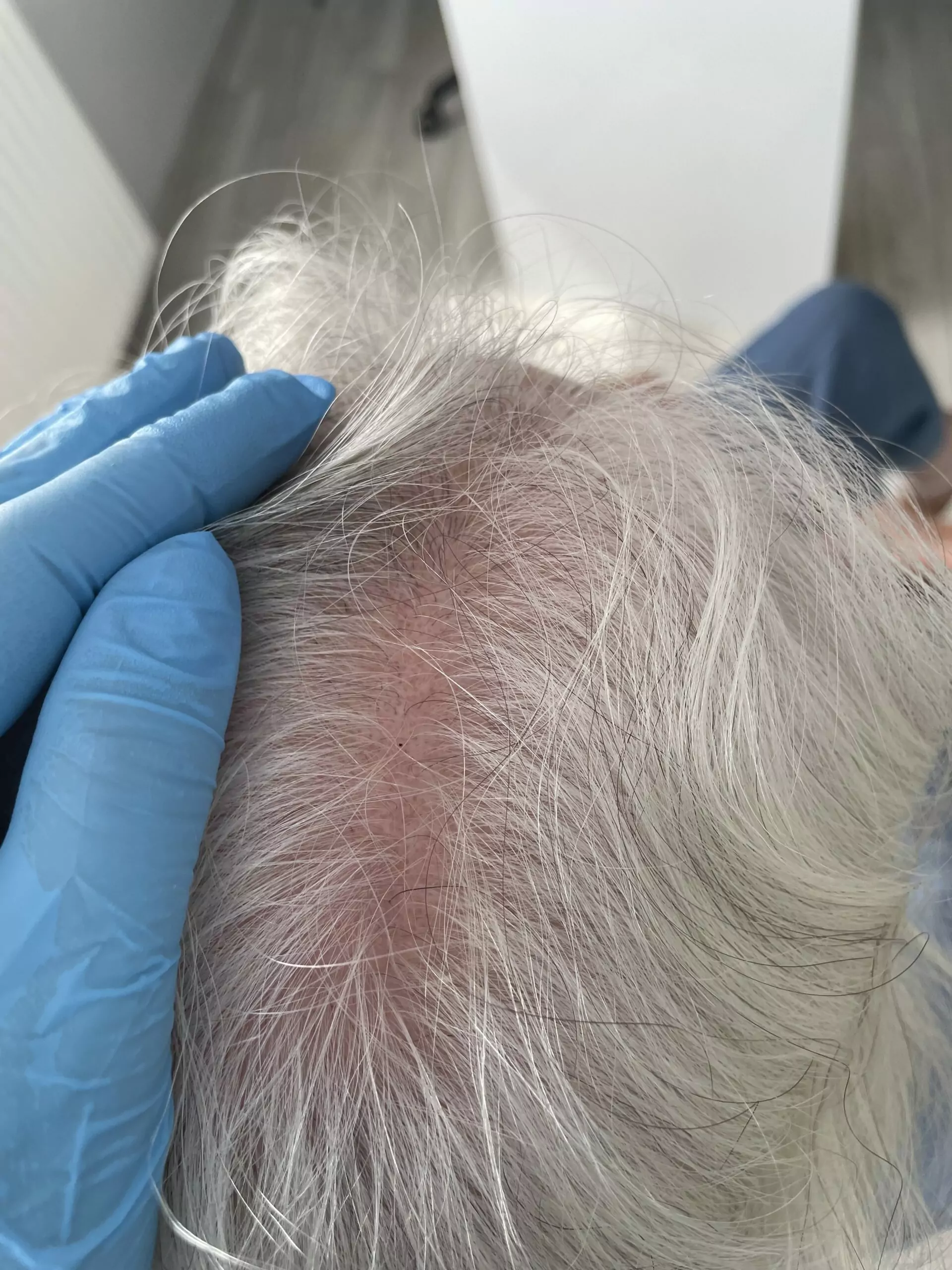 Łysienie bliznowaciejące Milena Kwaśniewska, specjalizuję się w diagnostyce i leczeniu problemów skóry głowy oraz włosów, oferując profesjonalne konsultacje i indywidualnie dobrane terapie. Nowa 15, 85-119 Bydgoszcz https://milena-trycholog.pl