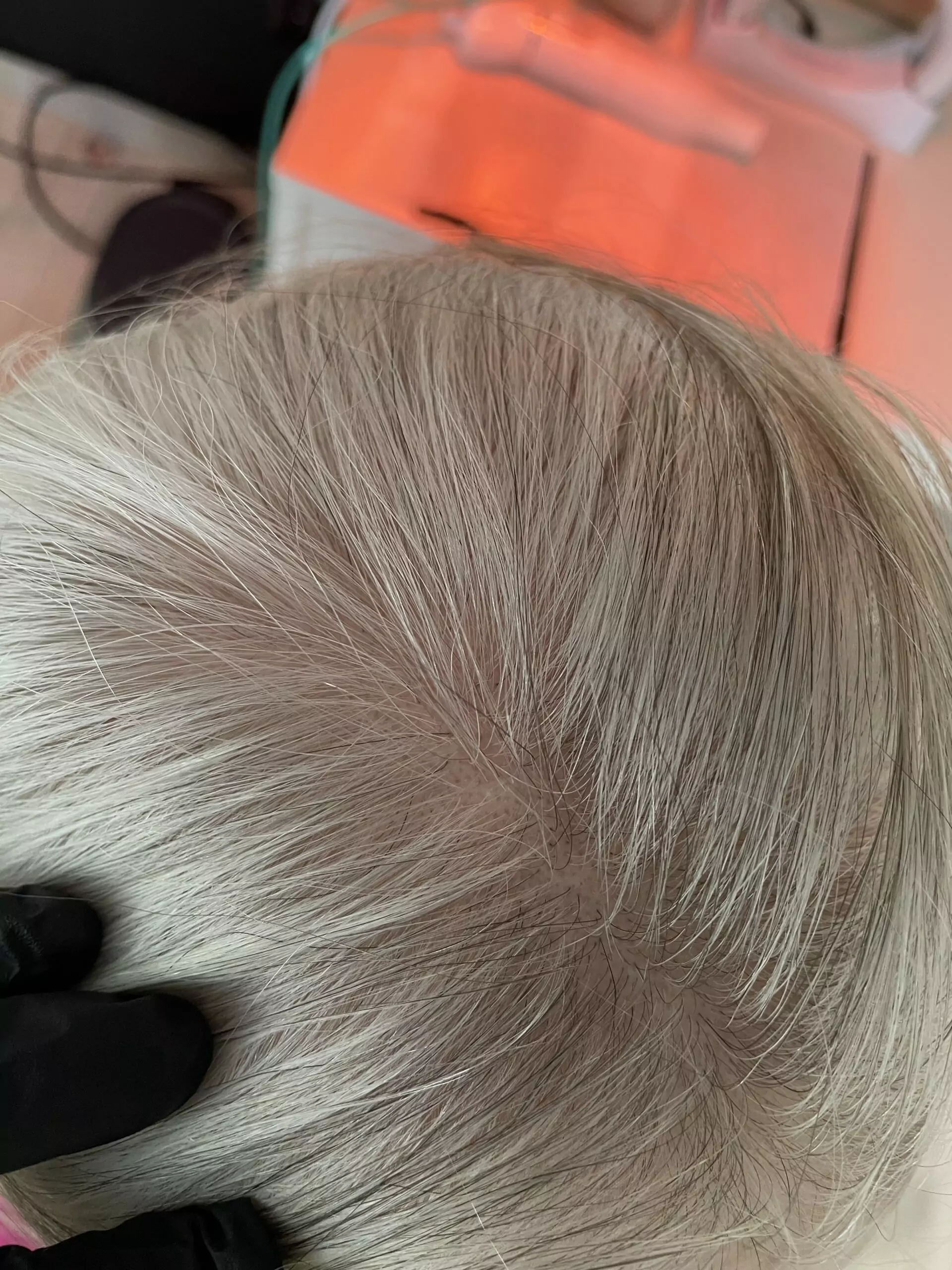 Łysienie bliznowaciejące Milena Kwaśniewska, specjalizuję się w diagnostyce i leczeniu problemów skóry głowy oraz włosów, oferując profesjonalne konsultacje i indywidualnie dobrane terapie. Nowa 15, 85-119 Bydgoszcz https://milena-trycholog.pl