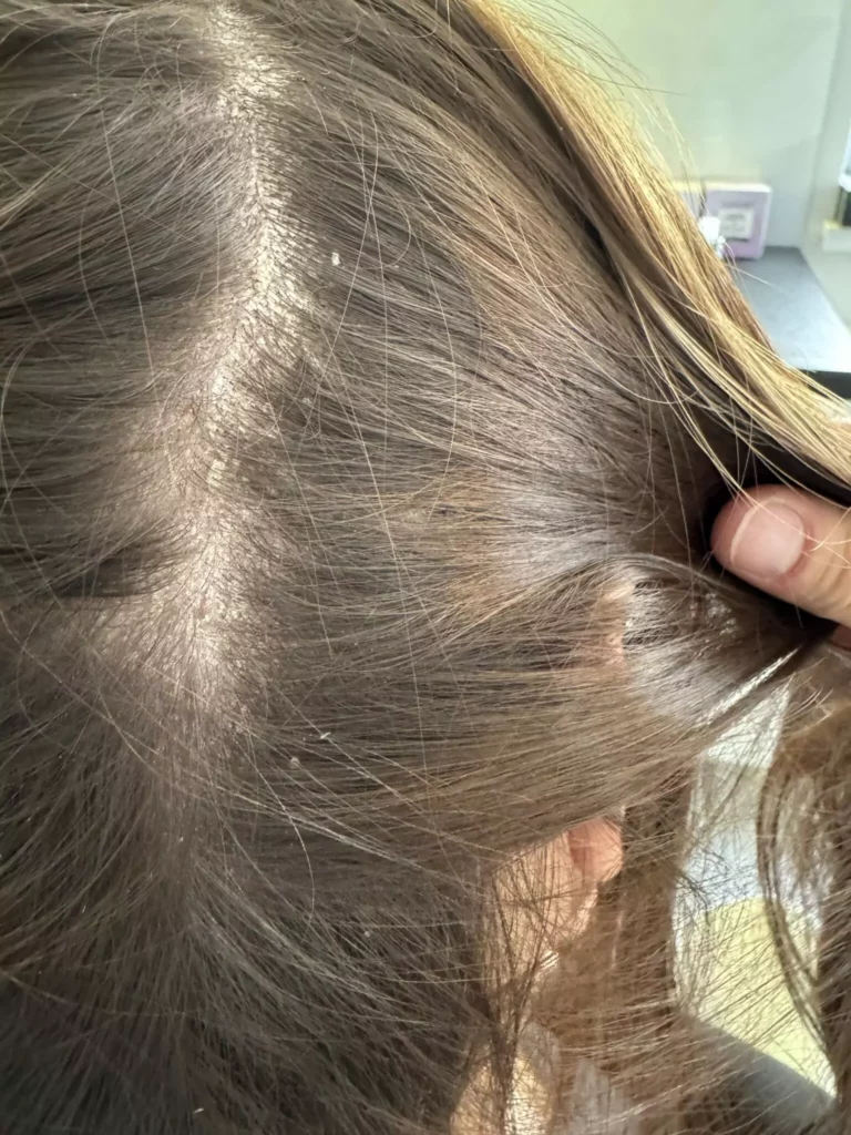 AZS i łuszczyca – jak rozpoznać i leczyć Milena Kwaśniewska, specjalizuję się w diagnostyce i leczeniu problemów skóry głowy oraz włosów, oferując profesjonalne konsultacje i indywidualnie dobrane terapie. Nowa 15, 85-119 Bydgoszcz https://milena-trycholog.pl