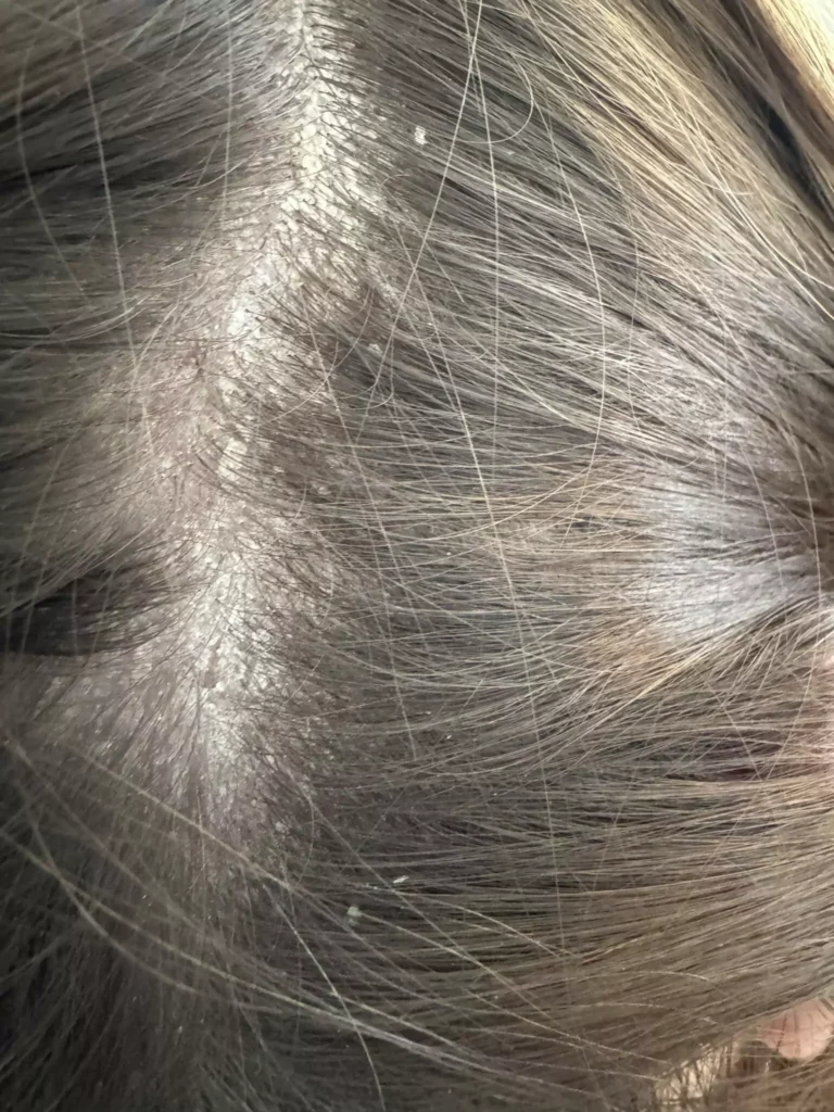 AZS i łuszczyca – jak rozpoznać i leczyć Milena Kwaśniewska, specjalizuję się w diagnostyce i leczeniu problemów skóry głowy oraz włosów, oferując profesjonalne konsultacje i indywidualnie dobrane terapie. Nowa 15, 85-119 Bydgoszcz https://milena-trycholog.pl