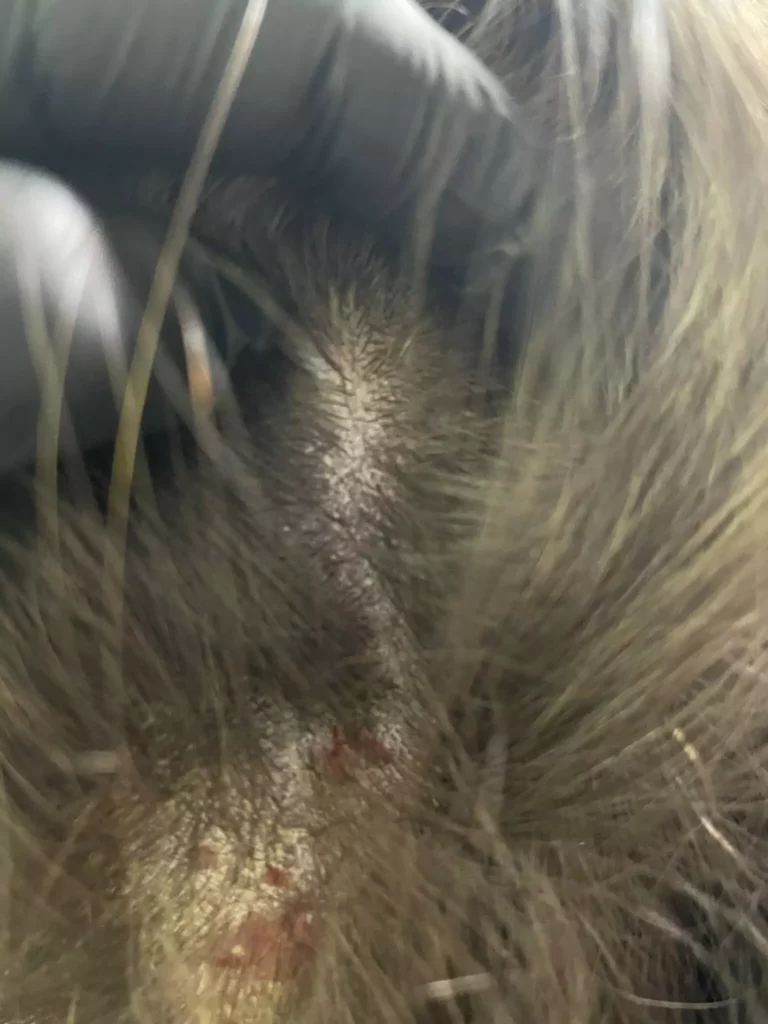 AZS i łuszczyca – jak rozpoznać i leczyć Milena Kwaśniewska, specjalizuję się w diagnostyce i leczeniu problemów skóry głowy oraz włosów, oferując profesjonalne konsultacje i indywidualnie dobrane terapie. Nowa 15, 85-119 Bydgoszcz https://milena-trycholog.pl