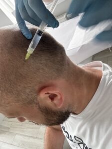 Pytania i odpowiedzi Zabiegi trychologiczne Trycholog Bydgoszcz – Milena Kwaśniewska, specjalizuję się w diagnostyce i leczeniu problemów skóry głowy oraz włosów, oferując profesjonalne konsultacje i indywidualnie dobrane terapie. Nowa 15, 85-119 Bydgoszcz https://milena-trycholog.pl CelltiLab Kosmetyki trychologiczne