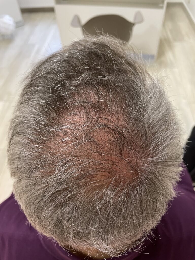 Konsultacja Trychologiczna Trycholog Bydgoszcz – Milena Kwaśniewska, specjalizuję się w diagnostyce i leczeniu problemów skóry głowy oraz włosów, oferując profesjonalne konsultacje i indywidualnie dobrane terapie. Nowa 15, 85-119 Bydgoszcz https://milena-trycholog.pl