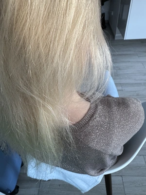 KPU, czyli kryptopiroluria, to zaburzenie metaboliczne związane z nieprawidłowym wydalaniem piroli – produktów ubocznych metabolizmu hemu. Pirole łączą się z witaminą B6, cynkiem i magnezem, a następnie są wydalane z moczem. W efekcie organizm traci cenne mikroskładniki, które są niezbędne dla zdrowia skóry, włosów, odporności i układu nerwowego.
Milena Trycholog Bydgoszcz