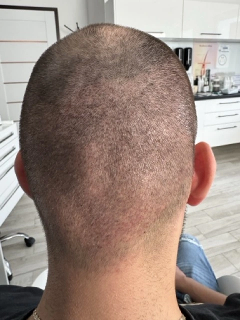 Przeszczep włosów - przygotowanie i pielęgnacja – efekty terapii Trycholog Bydgoszcz – Milena Kwaśniewska, Specjalizuję się w diagnostyce i leczeniu problemów skóry głowy oraz włosów, oferując w gabinecie „Trycholog Bydgoszcz Milena” przy ul. Nowej 15 profesjonalne konsultacje oraz indywidualnie dobrane terapie, aby Twoje włosy były zdrowe i piękne. https://milena-trycholog.pl Najlepszy Trycholog w Bydgoszczy