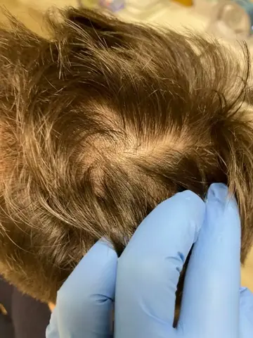 najczęstsze przyczyny wypadania włosów Trycholog Bydgoszcz – Milena Kwaśniewska, specjalizuję się w diagnostyce i leczeniu problemów skóry głowy oraz włosów, oferując profesjonalne konsultacje i indywidualnie dobrane terapie. Nowa 15, 85-119 Bydgoszcz https://milena-trycholog.pl