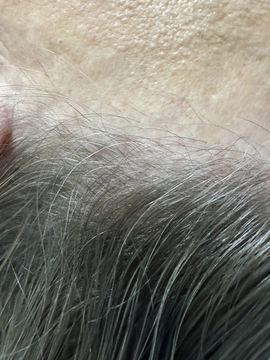 Łysienie bliznowaciejące czołowe FFA Trycholog Bydgoszcz – Milena Kwaśniewska, Specjalizuję się w diagnostyce i leczeniu problemów skóry głowy oraz włosów, oferując w gabinecie „Trycholog Bydgoszcz Milena” przy ul. Nowej 15 profesjonalne konsultacje oraz indywidualnie dobrane terapie, aby Twoje włosy były zdrowe i piękne. https://milena-trycholog.pl Najlepszy Trycholog w Bydgoszczy