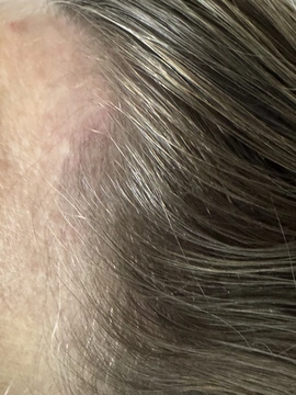 Łysienie bliznowaciejące czołowe FFA Trycholog Bydgoszcz – Milena Kwaśniewska, Specjalizuję się w diagnostyce i leczeniu problemów skóry głowy oraz włosów, oferując w gabinecie „Trycholog Bydgoszcz Milena” przy ul. Nowej 15 profesjonalne konsultacje oraz indywidualnie dobrane terapie, aby Twoje włosy były zdrowe i piękne. https://milena-trycholog.pl Najlepszy Trycholog w Bydgoszczy