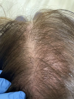 Łysienie Bliznowaciejące Holistyczne podejście Trycholog Bydgoszcz – Milena Kwaśniewska, Specjalizuję się w diagnostyce i leczeniu problemów skóry głowy oraz włosów, oferując w gabinecie „Trycholog Bydgoszcz Milena” przy ul. Nowej 15 profesjonalne konsultacje oraz indywidualnie dobrane terapie, aby Twoje włosy były zdrowe i piękne. https://milena-trycholog.pl Najlepszy Trycholog w Bydgoszczy