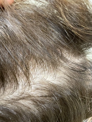 Łysienie Bliznowaciejące Holistyczne podejście Trycholog Bydgoszcz – Milena Kwaśniewska, Specjalizuję się w diagnostyce i leczeniu problemów skóry głowy oraz włosów, oferując w gabinecie „Trycholog Bydgoszcz Milena” przy ul. Nowej 15 profesjonalne konsultacje oraz indywidualnie dobrane terapie, aby Twoje włosy były zdrowe i piękne. https://milena-trycholog.pl Najlepszy Trycholog w Bydgoszczy