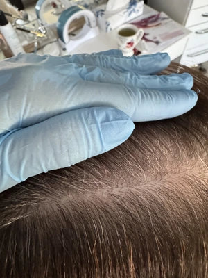 Łysienie Bliznowaciejące Holistyczne podejście Trycholog Bydgoszcz – Milena Kwaśniewska, Specjalizuję się w diagnostyce i leczeniu problemów skóry głowy oraz włosów, oferując w gabinecie „Trycholog Bydgoszcz Milena” przy ul. Nowej 15 profesjonalne konsultacje oraz indywidualnie dobrane terapie, aby Twoje włosy były zdrowe i piękne. https://milena-trycholog.pl Najlepszy Trycholog w Bydgoszczy