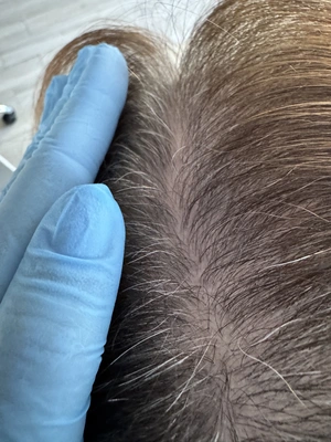 Łysienie Bliznowaciejące Holistyczne podejście Trycholog Bydgoszcz – Milena Kwaśniewska, Specjalizuję się w diagnostyce i leczeniu problemów skóry głowy oraz włosów, oferując w gabinecie „Trycholog Bydgoszcz Milena” przy ul. Nowej 15 profesjonalne konsultacje oraz indywidualnie dobrane terapie, aby Twoje włosy były zdrowe i piękne. https://milena-trycholog.pl Najlepszy Trycholog w Bydgoszczy