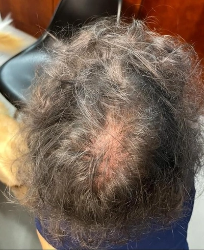 Łysienie Androgenowe Wypadanie Telogenowe Trycholog Bydgoszcz – Milena Kwaśniewska, Specjalizuję się w diagnostyce i leczeniu problemów skóry głowy oraz włosów, oferując w gabinecie „Trycholog Bydgoszcz Milena” przy ul. Nowej 15 profesjonalne konsultacje oraz indywidualnie dobrane terapie, aby Twoje włosy były zdrowe i piękne. https://milena-trycholog.pl Najlepszy Trycholog w Bydgoszczy