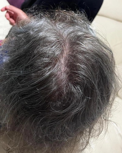 Łysienie Androgenowe Wypadanie Telogenowe Trycholog Bydgoszcz – Milena Kwaśniewska, Specjalizuję się w diagnostyce i leczeniu problemów skóry głowy oraz włosów, oferując w gabinecie „Trycholog Bydgoszcz Milena” przy ul. Nowej 15 profesjonalne konsultacje oraz indywidualnie dobrane terapie, aby Twoje włosy były zdrowe i piękne. https://milena-trycholog.pl Najlepszy Trycholog w Bydgoszczy