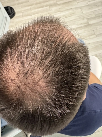 Łysienie androgenowe u mężczyzn, AGA, Trycholog Bydgoszcz – Milena Kwaśniewska, Specjalizuję się w diagnostyce i leczeniu problemów skóry głowy oraz włosów, oferując w gabinecie „Trycholog Bydgoszcz Milena” przy ul. Nowej 15 profesjonalne konsultacje oraz indywidualnie dobrane terapie, aby Twoje włosy były zdrowe i piękne. https://milena-trycholog.pl Najlepszy Trycholog w Bydgoszczy