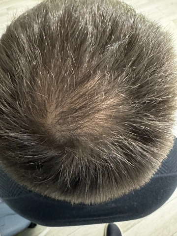 Łysienie androgenowe u mężczyzn, AGA, Trycholog Bydgoszcz – Milena Kwaśniewska, Specjalizuję się w diagnostyce i leczeniu problemów skóry głowy oraz włosów, oferując w gabinecie „Trycholog Bydgoszcz Milena” przy ul. Nowej 15 profesjonalne konsultacje oraz indywidualnie dobrane terapie, aby Twoje włosy były zdrowe i piękne. https://milena-trycholog.pl Najlepszy Trycholog w Bydgoszczy