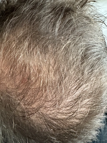 Łysienie androgenowe u mężczyzn, AGA, Trycholog Bydgoszcz – Milena Kwaśniewska, Specjalizuję się w diagnostyce i leczeniu problemów skóry głowy oraz włosów, oferując w gabinecie „Trycholog Bydgoszcz Milena” przy ul. Nowej 15 profesjonalne konsultacje oraz indywidualnie dobrane terapie, aby Twoje włosy były zdrowe i piękne. https://milena-trycholog.pl Najlepszy Trycholog w Bydgoszczy