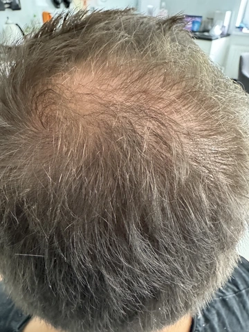 Łysienie androgenowe u mężczyzn, AGA, Trycholog Bydgoszcz – Milena Kwaśniewska, Specjalizuję się w diagnostyce i leczeniu problemów skóry głowy oraz włosów, oferując w gabinecie „Trycholog Bydgoszcz Milena” przy ul. Nowej 15 profesjonalne konsultacje oraz indywidualnie dobrane terapie, aby Twoje włosy były zdrowe i piękne. https://milena-trycholog.pl Najlepszy Trycholog w Bydgoszczy