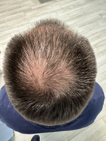 Łysienie androgenowe u mężczyzn, AGA, Trycholog Bydgoszcz – Milena Kwaśniewska, Specjalizuję się w diagnostyce i leczeniu problemów skóry głowy oraz włosów, oferując w gabinecie „Trycholog Bydgoszcz Milena” przy ul. Nowej 15 profesjonalne konsultacje oraz indywidualnie dobrane terapie, aby Twoje włosy były zdrowe i piękne. https://milena-trycholog.pl Najlepszy Trycholog w Bydgoszczy