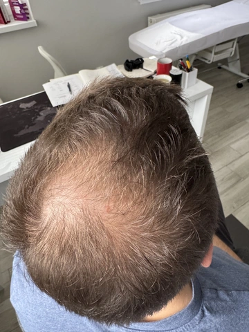 Łysienie androgenowe u mężczyzn, AGA, Trycholog Bydgoszcz – Milena Kwaśniewska, Specjalizuję się w diagnostyce i leczeniu problemów skóry głowy oraz włosów, oferując w gabinecie „Trycholog Bydgoszcz Milena” przy ul. Nowej 15 profesjonalne konsultacje oraz indywidualnie dobrane terapie, aby Twoje włosy były zdrowe i piękne. https://milena-trycholog.pl Najlepszy Trycholog w Bydgoszczy