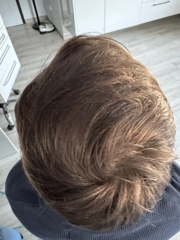 Łysienie u mężczyzn, łysienie androgenowe Trycholog Bydgoszcz Milena - ul. Nowa 15, 86-119 Bydgoszcz, tel. 571 280 110