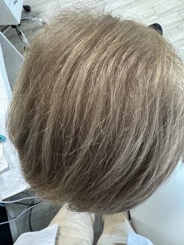 Łysienie u mężczyzn, łysienie androgenowe Trycholog Bydgoszcz Milena - ul. Nowa 15, 86-119 Bydgoszcz, tel. 571 280 110