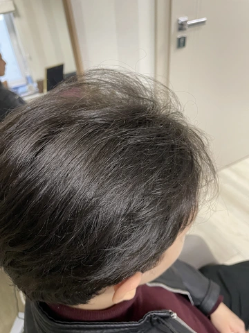 Łysienie u mężczyzn, łysienie androgenowe Trycholog Bydgoszcz Milena - ul. Nowa 15, 86-119 Bydgoszcz, tel. 571 280 110