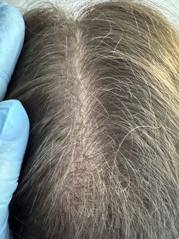 Łysienie u mężczyzn, łysienie androgenowe Trycholog Bydgoszcz Milena - ul. Nowa 15, 86-119 Bydgoszcz, tel. 571 280 110