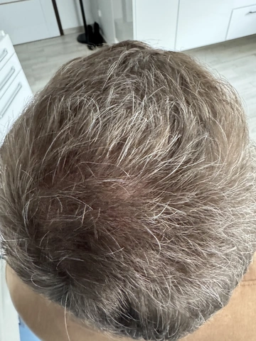 Łysienie u mężczyzn, łysienie androgenowe Trycholog Bydgoszcz Milena - ul. Nowa 15, 86-119 Bydgoszcz, tel. 571 280 110