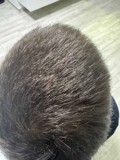 Łysienie u mężczyzn, łysienie androgenowe Trycholog Bydgoszcz Milena - ul. Nowa 15, 86-119 Bydgoszcz, tel. 571 280 110