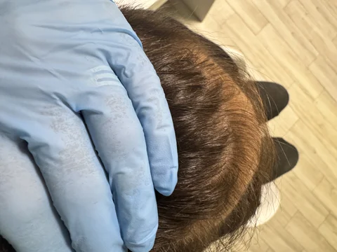 Łysienie u mężczyzn, łysienie androgenowe Trycholog Bydgoszcz Milena - ul. Nowa 15, 86-119 Bydgoszcz, tel. 571 280 110