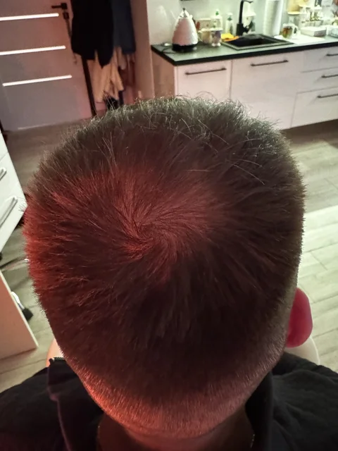 Łysienie u mężczyzn, łysienie androgenowe Trycholog Bydgoszcz Milena - ul. Nowa 15, 86-119 Bydgoszcz, tel. 571 280 110