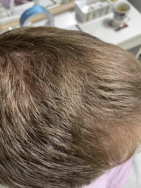 Łysienie u mężczyzn, łysienie androgenowe Trycholog Bydgoszcz Milena - ul. Nowa 15, 86-119 Bydgoszcz, tel. 571 280 110