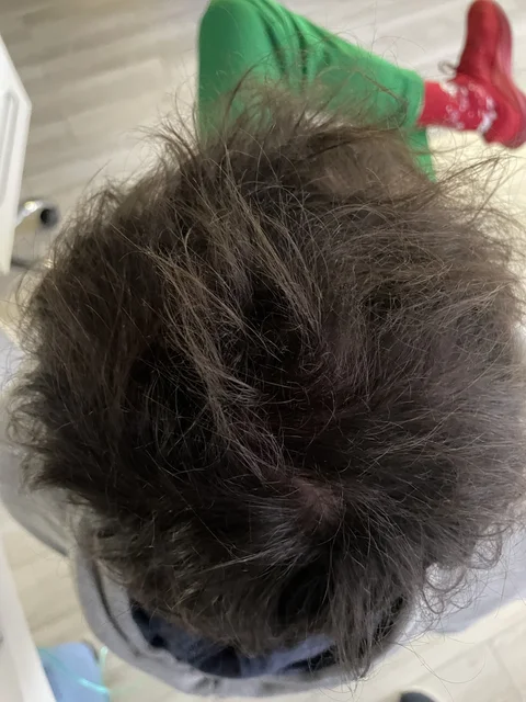 Łysienie u mężczyzn, łysienie androgenowe Trycholog Bydgoszcz Milena - ul. Nowa 15, 86-119 Bydgoszcz, tel. 571 280 110