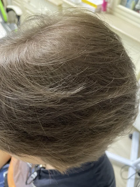 Łysienie u mężczyzn, łysienie androgenowe Trycholog Bydgoszcz Milena - ul. Nowa 15, 86-119 Bydgoszcz, tel. 571 280 110